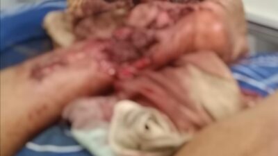 Perjuangan Firman Jaya Halawa: Terpinggirkan Tanpa Santunan setelah Kecelakaan Kerja Tragis di Kebun Sawit PT PHI